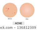 Vector illustration showing acne skin condition before and after treatment. 136812309