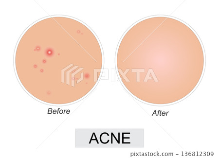 Vector illustration showing acne skin condition before and after treatment. 136812309