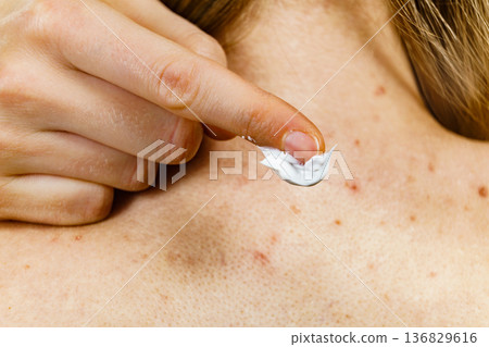 Woman with pimple on back applying medical ointmeny Woman with pimple on back applying medical ointmeny 136829616
