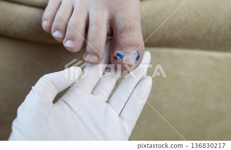 Ingrown toenail treatment with titanium nail brace and corrective system applied by podologist, pincer nail correction using orthonyxia technique in medical clinic. Ingrown toenail treatment with titanium nail brace and corrective system applied by podologist, pincer nail correction using orthonyxia technique in medical clinic. 136830217