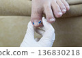 Ingrown toenail treatment with titanium nail brace and corrective system applied by podologist, pincer nail correction using orthonyxia technique in medical clinic. Ingrown toenail treatment with titanium nail brace and corrective system applied by podologist, pincer nail correction using orthonyxia technique in medical clinic. 136830218