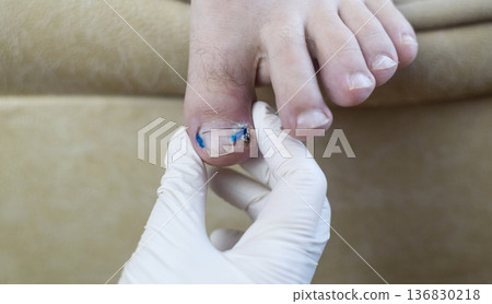 Ingrown toenail treatment with titanium nail brace and corrective system applied by podologist, pincer nail correction using orthonyxia technique in medical clinic. Ingrown toenail treatment with titanium nail brace and corrective system applied by podologist, pincer nail correction using orthonyxia technique in medical clinic. 136830218