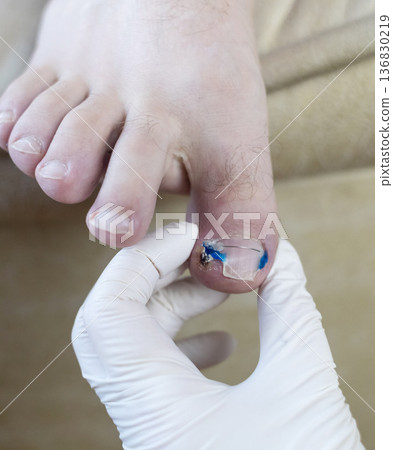 Ingrown toenail treatment with titanium nail brace and corrective system applied by podologist, pincer nail correction using orthonyxia technique in medical clinic. Ingrown toenail treatment with titanium nail brace and corrective system applied by podologist, pincer nail correction using orthonyxia technique in medical clinic. 136830219