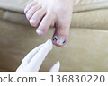 Ingrown toenail treatment with titanium nail brace and corrective system applied by podologist, pincer nail correction using orthonyxia technique in medical clinic. 136830220