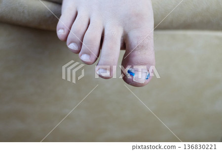 Ingrown toenail treatment with titanium nail brace and corrective system applied by podologist, pincer nail correction using orthonyxia technique in medical clinic. 136830221