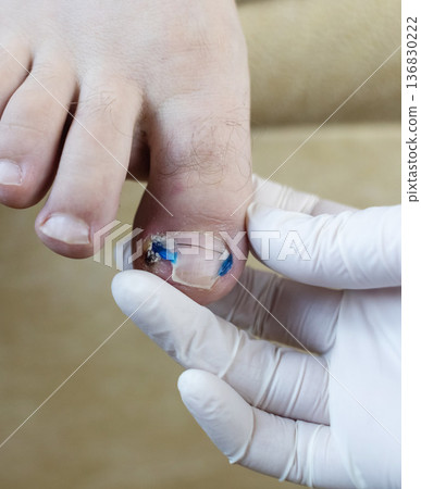 Ingrown toenail treatment with titanium nail brace and corrective system applied by podologist, pincer nail correction using orthonyxia technique in medical clinic. 136830222
