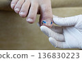 Ingrown toenail treatment with titanium nail brace and corrective system applied by podologist, pincer nail correction using orthonyxia technique in medical clinic. 136830223