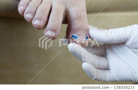Ingrown toenail treatment with titanium nail brace and corrective system applied by podologist, pincer nail correction using orthonyxia technique in medical clinic. 136830223
