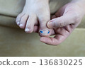 Ingrown toenail treatment with titanium nail brace and corrective system applied by podologist, pincer nail correction using orthonyxia technique in medical clinic. 136830225