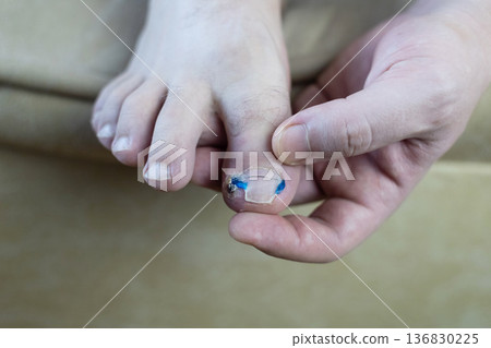 Ingrown toenail treatment with titanium nail brace and corrective system applied by podologist, pincer nail correction using orthonyxia technique in medical clinic. 136830225
