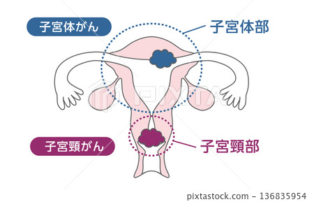 子宮頸癌和子宮內膜癌的醫學插圖 136835954