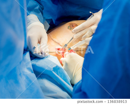 Surgery to remove the breast and replace it with an implant. Surgery to remove the breast and replace it with an implant. 136838913