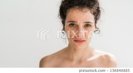 portrait of a young teenage girl with pimples and acne on problematic facial skin. Face of adult woman with bad red inflamed skin and acne a white isolated background portrait of a young teenage girl with pimples and acne on problematic facial skin. Face of adult woman with bad red inflamed skin and acne a white isolated background 136840885
