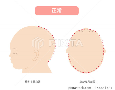 Illustration of a baby with a normal head shape seen from the side and directly above. Comparison with plagiocephaly, brachycephaly, and dolicocephaly. 136841585