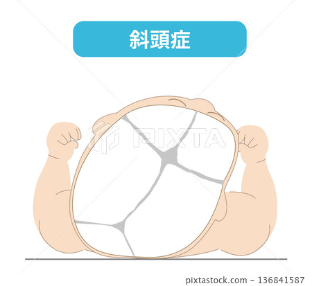 Sleeping posture: The mechanism by which the head shape of a baby is distorted depending on the direction of the head while sleeping, plagiocephaly, brachycephaly, dolicocephaly Sleeping posture: The mechanism by which the head shape of a baby is distorted depending on the direction of the head while sleeping, plagiocephaly, brachycephaly, dolicocephaly 136841587