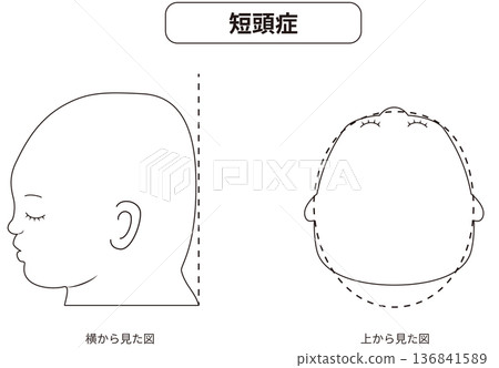 黑白線條畫：描繪一名患有斜頭畸形、短頭畸形或長頭畸形的嬰兒，從側面和正上方觀察，可見其頭部形狀扭曲。 136841589