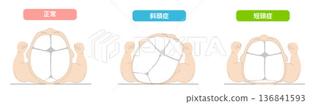 睡眠姿勢：嬰兒頭部形狀因睡眠時頭部位置而扭曲的機制，包括斜頭畸形、短頭畸形和長頭畸形。 136841593