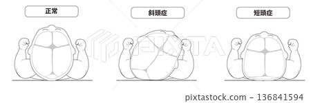 一幅黑白線條畫，描繪了一個熟睡的嬰兒。圖中展示了睡眠時頭部形狀會因頭部方向而扭曲的機制，即斜頭畸形和短頭畸形。 136841594