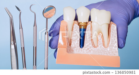Dental Implant Crown Cross Section Model with Dentist Instruments in Blue Medical Glove on Light Blue Background, Implantology Concept Dental Implant Crown Cross Section Model with Dentist Instruments in Blue Medical Glove on Light Blue Background, Implantology Concept 136850981