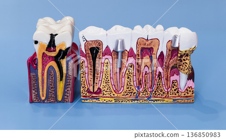 Detailed Dental Anatomy Teaching Model with Tooth Cross Sections, Implant and Root Canal on Blue Background 136850983