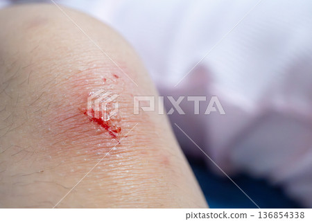 wound on child knee after fall on the ground 136854338