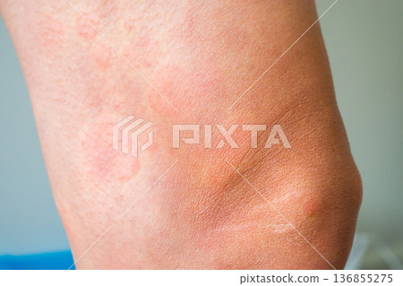 Young asian man has allergic skin rash on his legs from itchy dry skin eczema dermatitis insect bites 136855275
