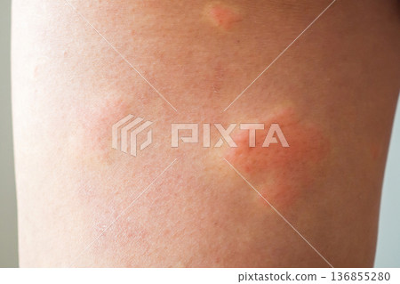 Young asian man has allergic skin rash on his legs from itchy dry skin eczema dermatitis insect bites 136855280