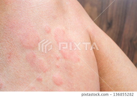 Young asian man has allergic skin rash on his legs from itchy dry skin eczema dermatitis insect bites 136855282