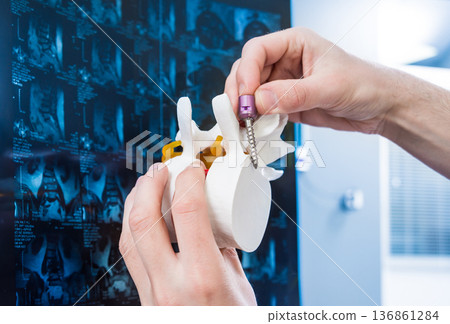 Doctor show polyaxial screw on the spine model. Spine fixation systems Doctor show polyaxial screw on the spine model. Spine fixation systems 136861284