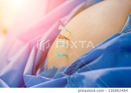 Arthroscope surgery. Orthopedic surgeons in teamwork in the operating room  136862464