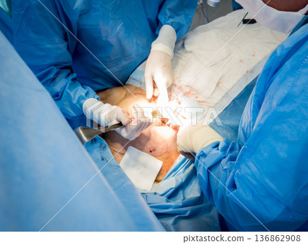 Surgery to remove the breast and replace it with an implant. Surgery to remove the breast and replace it with an implant. 136862908