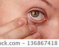 Macro Eye. Woman checking eyeball. Beautiful woman pulls her lower eyelid down to reveal the whites of the eye. Checking for foreign bodies and signs of illness. Optician, Ophthalmology Clinic 136867418