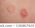 Closeup Inflamed Skin Lesions Showing Scab, Redness, Patient Torso Patch With Surrounding Lighter Discoloration, Moist Crust And Rough Texture, Clinical Dermatology, Epidermal Detail, Derma 136867420