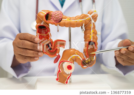 Colorectal cancer, doctor holding intestine colon human anatomy model. Colorectal cancer, doctor holding intestine colon human anatomy model. 136877359