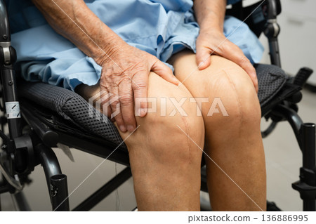 Asian elderly woman patient with scar knee replacement surgery in hospital. Asian elderly woman patient with scar knee replacement surgery in hospital. 136886995