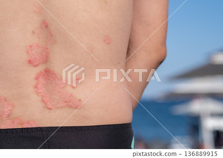 Visible Psoriasis Lesions on a Persons Back Near the Beach During Summer, Highlighting the Skin Condition in a Sunny Outdoor Setting Visible Psoriasis Lesions on a Persons Back Near the Beach During Summer, Highlighting the Skin Condition in a Sunny Outdoor Setting 136889915