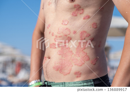 Individual With Psoriasis Showing Skin Condition During a Sunny Day at the Beach Individual With Psoriasis Showing Skin Condition During a Sunny Day at the Beach 136889917