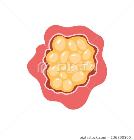 Cancerous tumor, cancer cell growth. cancer disease concept Cancerous tumor, cancer cell growth. cancer disease concept 136890500
