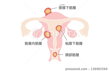 Illustrated guide to types of uterine fibroids (intramural fibroids, submucosal fibroids, subserosal fibroids, cervical fibroids) 136905569