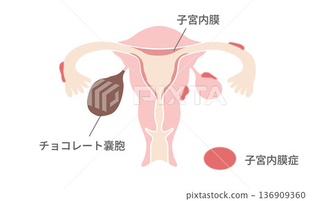 Illustration of endometriosis and chocolate cysts – differences in location and structure Illustration of endometriosis and chocolate cysts – differences in location and structure 136909360