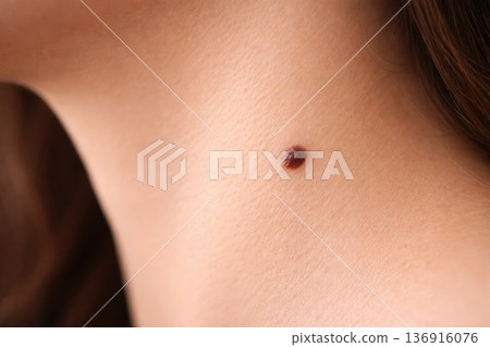 Close up of skin mole on human body dermatology and health concept 136916076