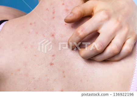 Woman with skin problem acne on back 136922196
