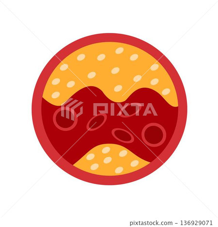 artery clogged with cholesterol artery clogged with cholesterol 136929071