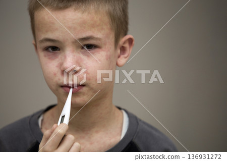 Portrait of sick sad boy child with thermometer having fever suffering from measles or chicken pox with bumps all over face. Contagious child diseases and treatment. Portrait of sick sad boy child with thermometer having fever suffering from measles or chicken pox with bumps all over face. Contagious child diseases and treatment. 136931272