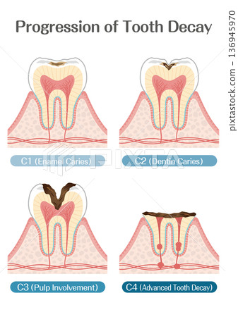 Illustration of tooth decay progression stages C1 to C4 Illustration of tooth decay progression stages C1 to C4 136945970