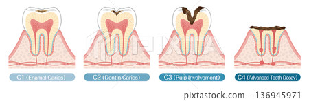 齲齒發展階段 C1 至 C4 的示意圖 136945971