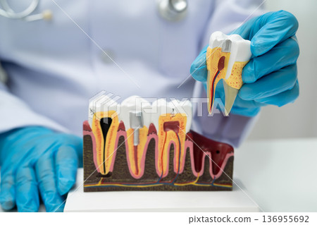 Dentist holding dental implant, artificial tooth roots into jaw, root canal of dental treatment, gum disease, teeth model for dentist. Dentist holding dental implant, artificial tooth roots into jaw, root canal of dental treatment, gum disease, teeth model for dentist. 136955692