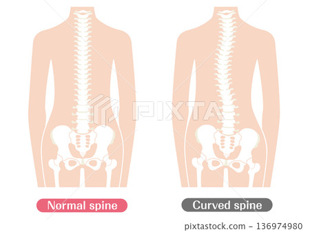Comparison illustration of normal and abnormal spine | Color 136974980