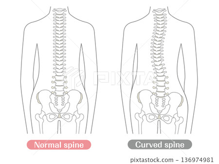 Comparison illustration of normal and abnormal spine | Line Comparison illustration of normal and abnormal spine | Line 136974981