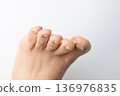 Toenails showing symptoms of ingrown or ingrown nails 136976835